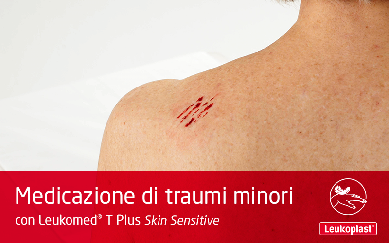 In questo video è mostrato come le abrasioni della pelle possono essere evitate nella pelle dell'anziano: vediamo un operatore sanitario che medica l'abrasione sulla spalla di una donna anziana utilizzando Leukomed T Plus Skin Sensitive. In questo video è mostrato come le abrasioni della pelle possono essere evitate nella pelle dell'anziano: vediamo un operatore sanitario che medica l'abrasione sulla spalla di una donna anziana utilizzando Leukomed T Plus Skin Sensitive.